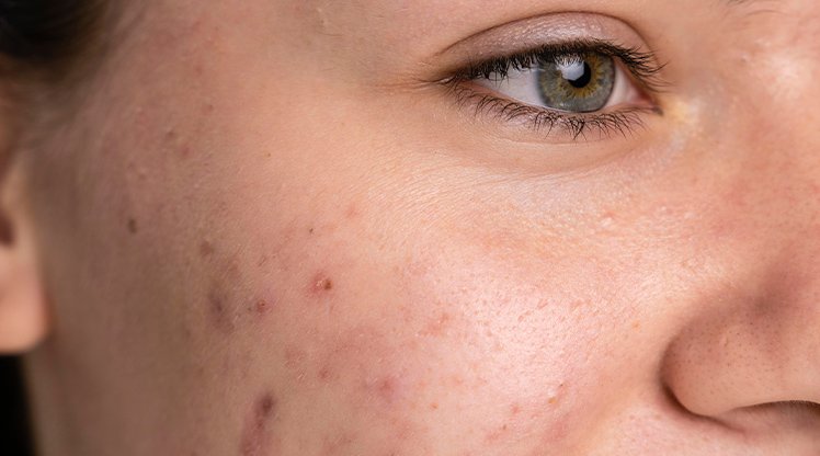 Gesichtsausschnitt einer jungen Frau mit Hautunreinheiten auf der rechten Wange