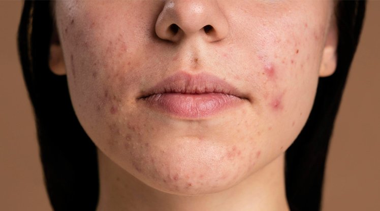 Gesichtsausschnitt einer jungen Frau mit Hautunreinheiten