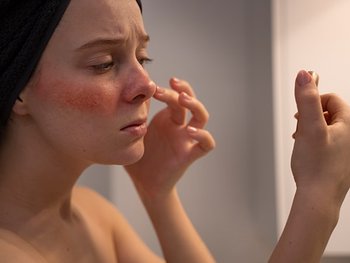 Gesicht einer Frau mit empfindlicher Haut und Rötungen beim Auftragen von Hautpflege