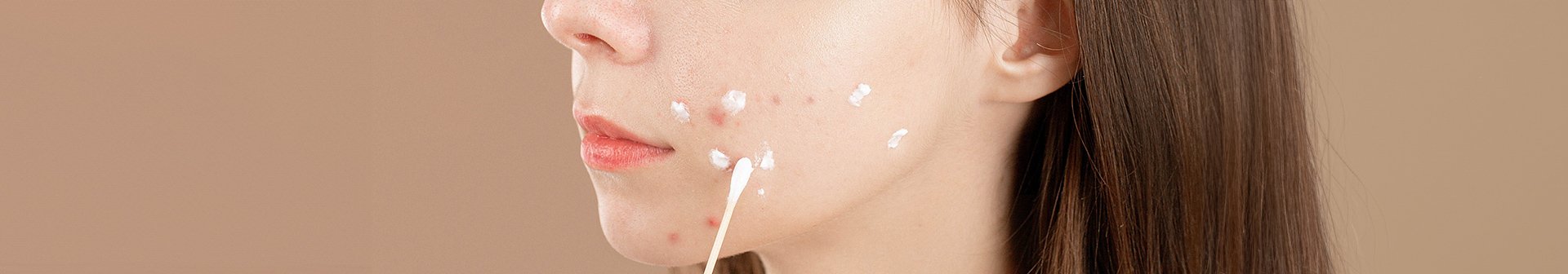 Eine Frau mit unreiner Haut trägt Creme mit einem Wattestäbchen auf ihre Pickel auf