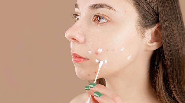Eine Frau mit unreiner Haut trägt Creme mit einem Wattestäbchen auf ihre Pickel auf