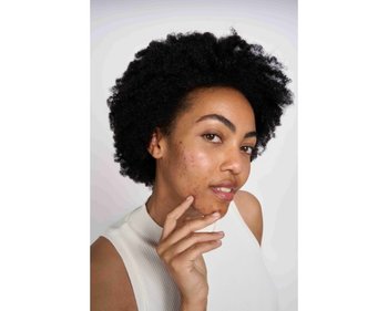 Junge Frau mit gereinigter Haut, aber mit Aknenarben im Gesicht blickt selbstbewusst in die Kamera