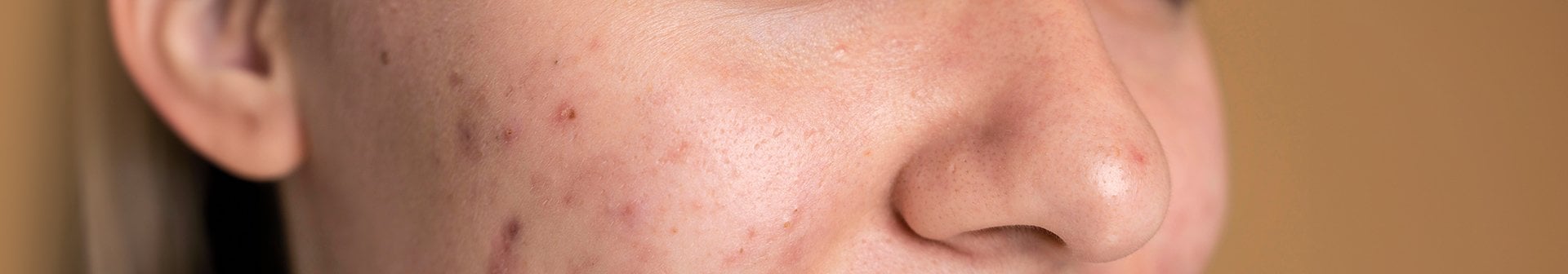 Gesichtsausschnitt einer jungen Frau mit Hautunreinheiten auf der rechten Wange