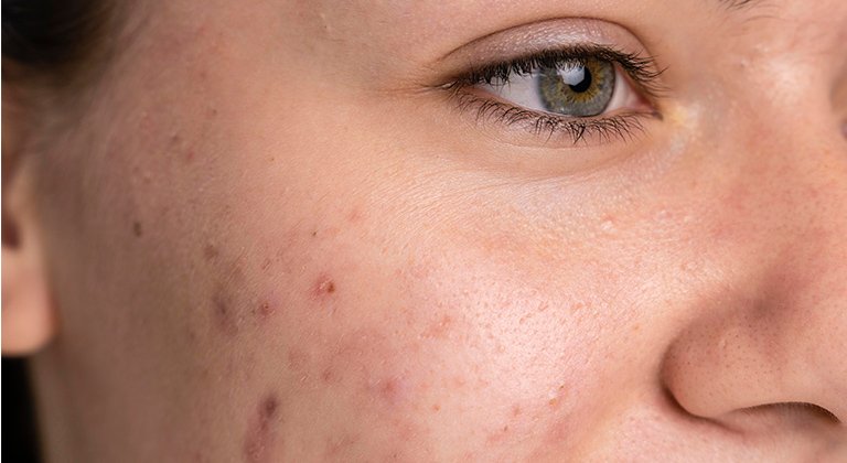 Gesichtsausschnitt einer jungen Frau mit Hautunreinheiten auf der rechten Wange