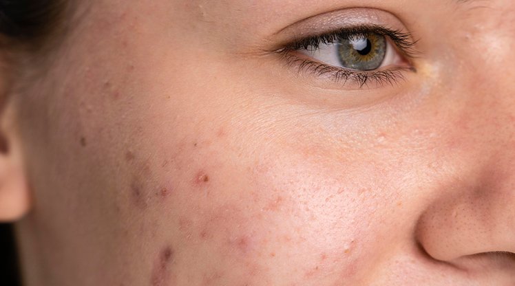 glutathion haut aufhellen Effektive Hautaufhellung: Strahlende, ebenmäßige Haut