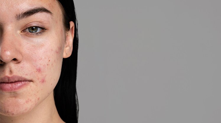 Gesichtshälfte einer brünetten Frau mit Hautrötungen im Gesicht