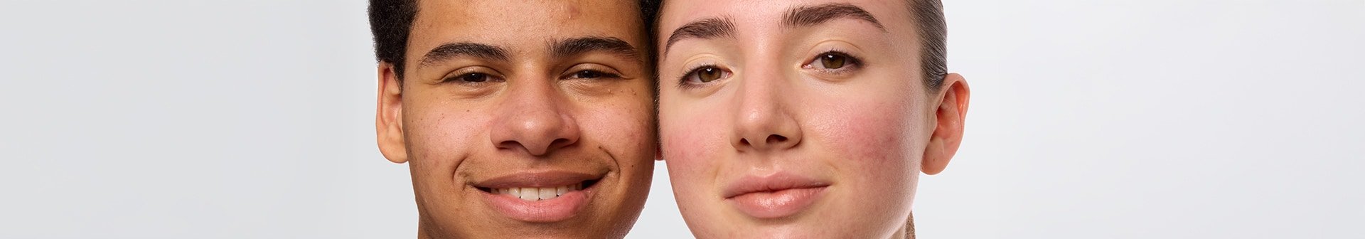 Zwei junge Menschen mit sichtbarer Akne schauen in die Kamera.