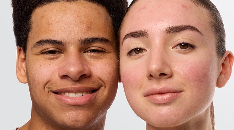 Zwei junge Menschen mit sichtbarer Akne schauen in die Kamera.