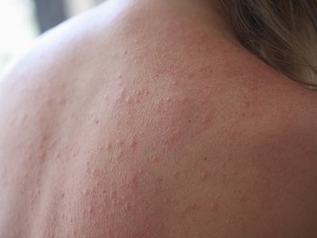 Rücken einer Frau, der mit Mallorca-Akne bedeckt ist