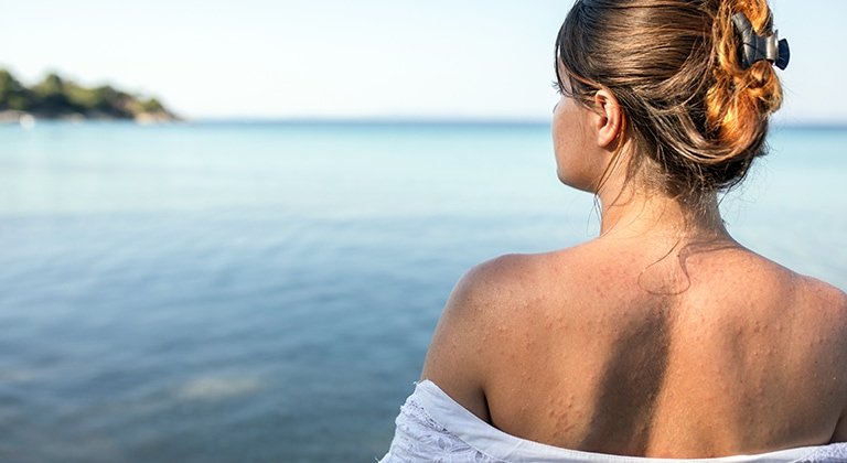 Frau steht am Wasser, schaut in die Ferne und hat ihren Rücken entblößt, auf dem Mallorca-Akne zu sehen ist