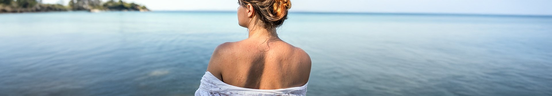 Frau steht am Wasser, schaut in die Ferne und hat ihren Rücken entblößt, auf dem Mallorca-Akne zu sehen ist