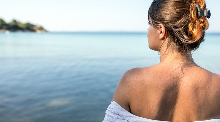 Mallorca-Akne: Tipps, Ursachen & Sonnenschutz | Garnier