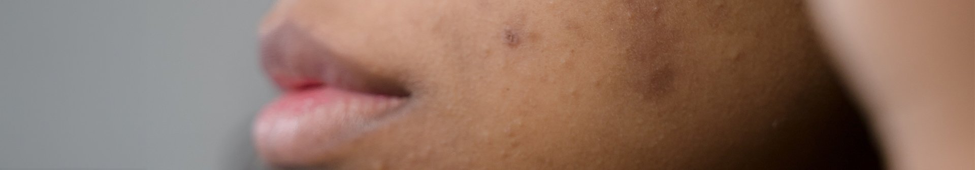 Ausschnitt eines Frauengesichts mit Melasma auf der unteren Wangenpartie