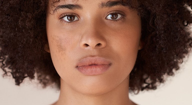 250414 melasma data small screen 768x420px