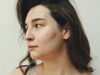 Gesicht einer Frau von der Seiten mit Unreinheiten und Pickeln auf der Wange