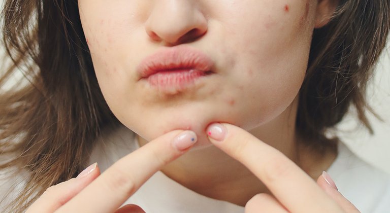 Gesicht einer Frau von der Nase bis zum Kinn mit braunen Haaren, die mit zwei Fingern einen Pickel am Kinn ausdrückt
