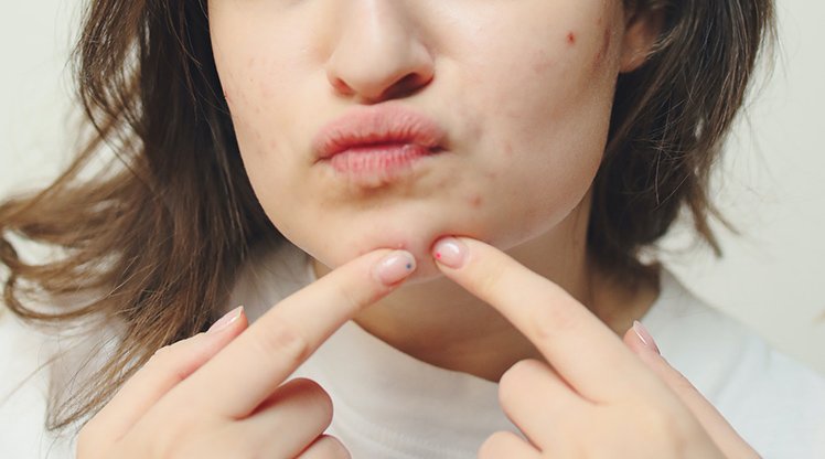 Gesicht einer Frau von der Nase bis zum Kinn mit braunen Haaren, die mit zwei Fingern einen Pickel am Kinn ausdrückt