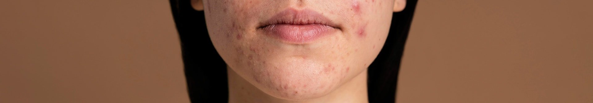 Nahaufnahme pickeliger Haut im Kinnbereich