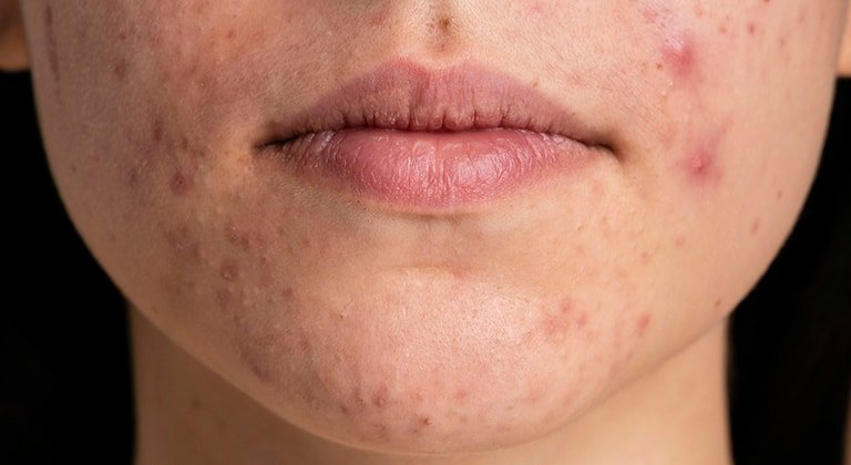 Nahaufnahme pickeliger Haut im Kinnbereich