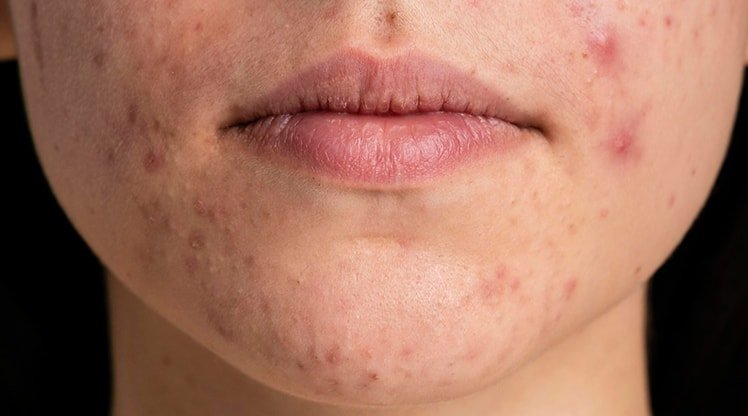 Pickel am Kinn: Ursachen und die besten Tipps! | Garnier