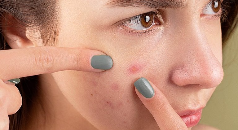 Pickel ausdrcken: Tipps, Risiken & sanfte Alternativen | Garnier Pickel ausdrcken: Tipps, Risiken & sanfte Alternativen | Garnier