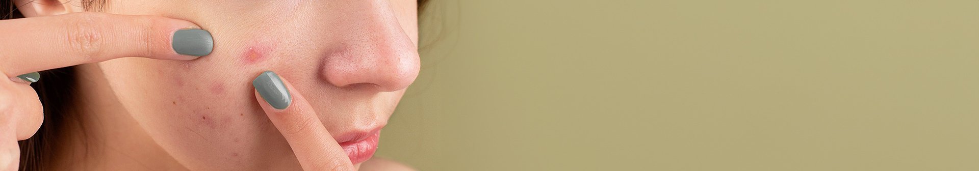 Frau möchte im Gesicht Pickel ausdrücken