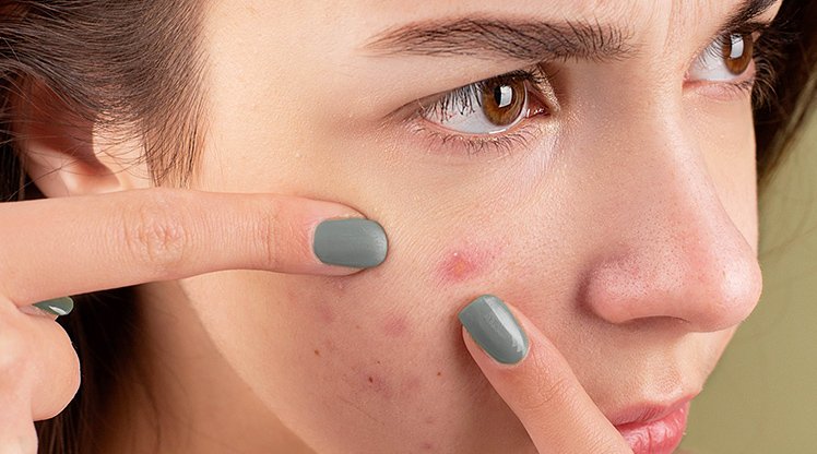 Pickel ausdrücken - ja oder nein? Tipps | Garnier