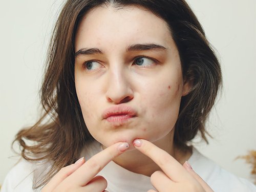 Pickel ausdrücken - ja oder nein? Tipps | Garnier