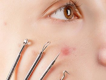 Nahaufnahme eines Gesichts mit Komedonenquetscher und anderen Werkzeugen zum Pickel ausdrücken”