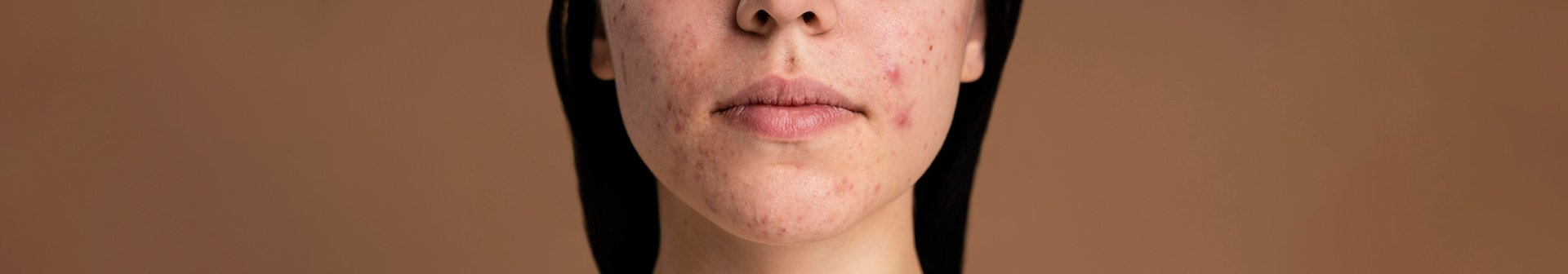 Gesichtsausschnitt einer jungen Frau mit Hautunreinheiten