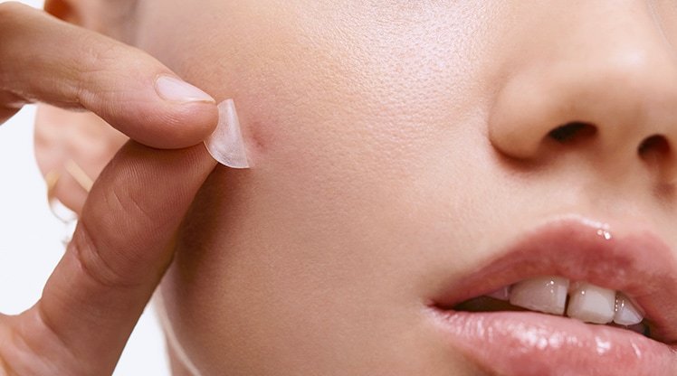 Garnier Pickel Patches für reine Haut – Frau zieht einen Pickel Patch gegen Unreinheiten von der Haut ab