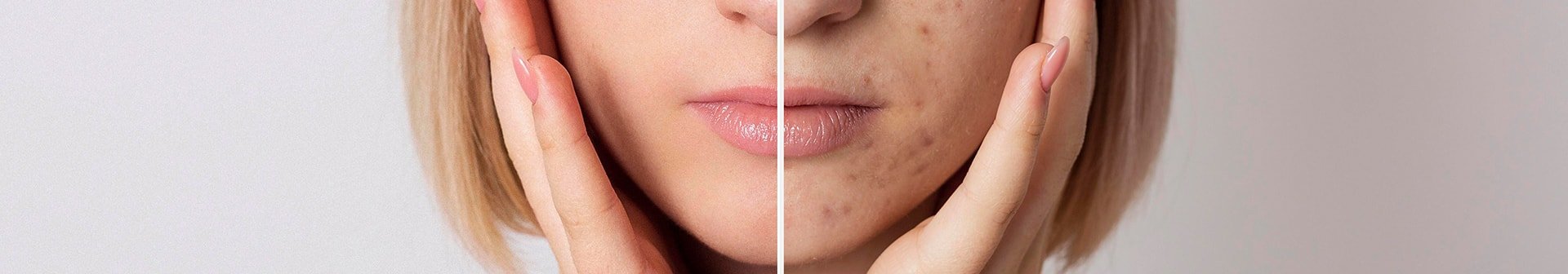 Aufnahme eines Frauengesichts ohne Pickel (links) und mit Pickeln (rechts)