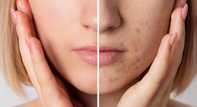 Aufnahme eines Frauengesichts ohne Pickel (links) und mit Pickeln (rechts)