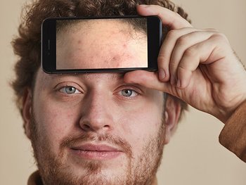 Ein junger Mann hält ein Telefon vor seine Stirn mit einem Foto von dieser mit Pickeln