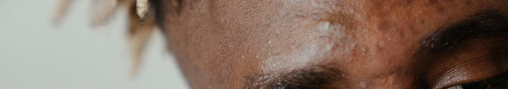 Stirn eines Mannes mit Pickeln