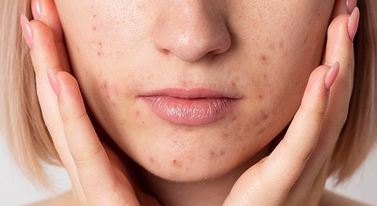 Frau mit Pickelmalen die ihr Gesicht in den Händen hält