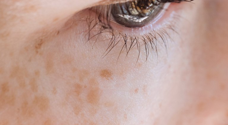 Nahaufnahme einer Hautpartie mit Pigmentflecken
