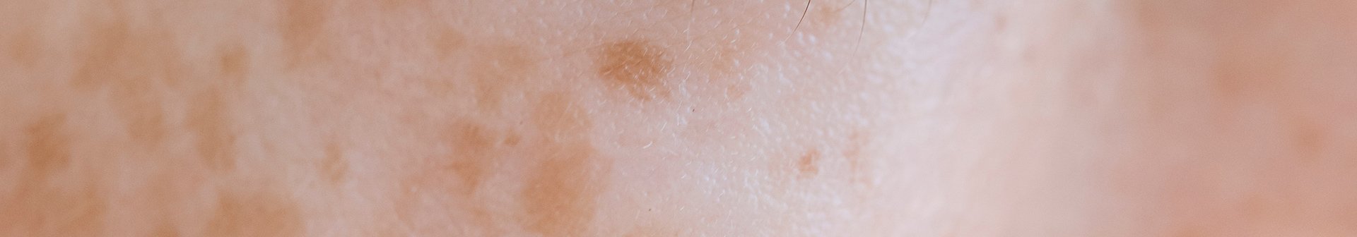 Nahaufnahme einer Hautpartie mit Pigmentflecken