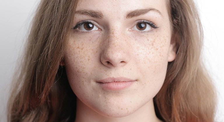 Aufnahme der Gesichtspartie um die Nase mit Pigmentflecken auf den Wangen