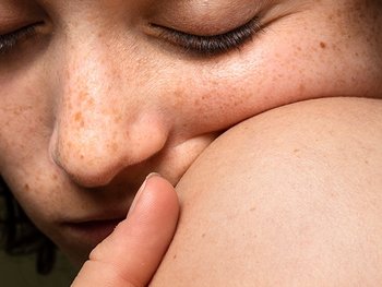 Gesicht einer Frau mit Sommersprossen und Pigmentflecken, die sich an ihrer Schulter festhält