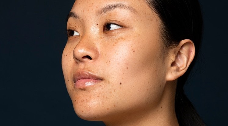 Mund und Nase einer Frau mit Pigmentflecken vor einem schwarzen Hintergrund