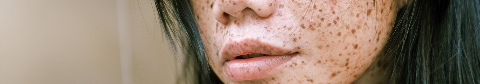 Eine junge Frau mit Pigmentstörungen im Gesicht