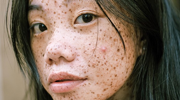 Eine junge Frau mit Pigmentstörungen im Gesicht