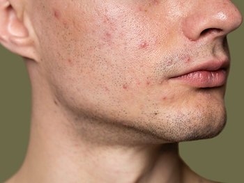 Gesicht eines Mannes mit Pickeln und Unreinheiten