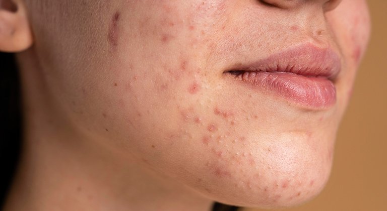 Nahaufnahme vom Gesicht einer Frau mit trockener Haut