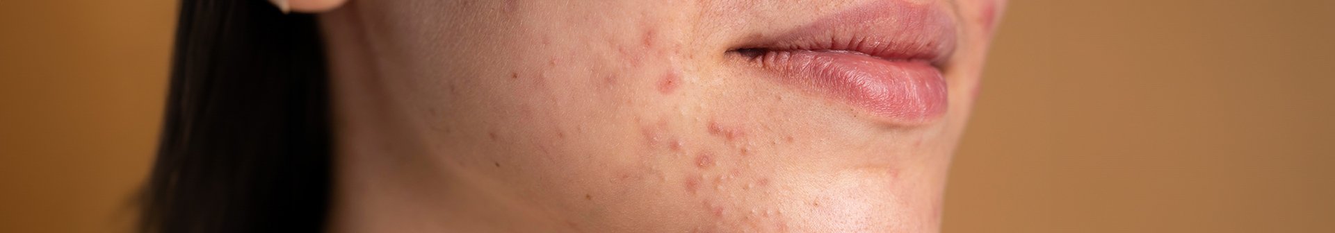 Nahaufnahme vom Gesicht einer Frau mit trockener Haut