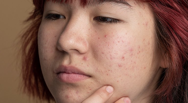 Frau mit unterirdischen Pickeln im Gesicht überlegt, wie sie verkapselte Pickel unter der Haut behandeln kann