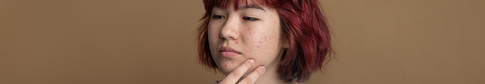 Frau mit unterirdischen Pickeln im Gesicht überlegt, wie sie verkapselte Pickel unter der Haut behandeln kann