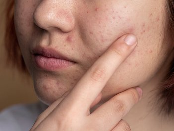 Nahaufnahme einer Frau, die auf ihre Wange mit Akne zeigt