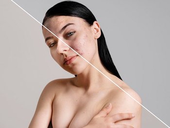 Junge Frau diagonal geteilt als Vorher-Nachher-Vergleich für die Anwendung von Vitamin C bei Akne